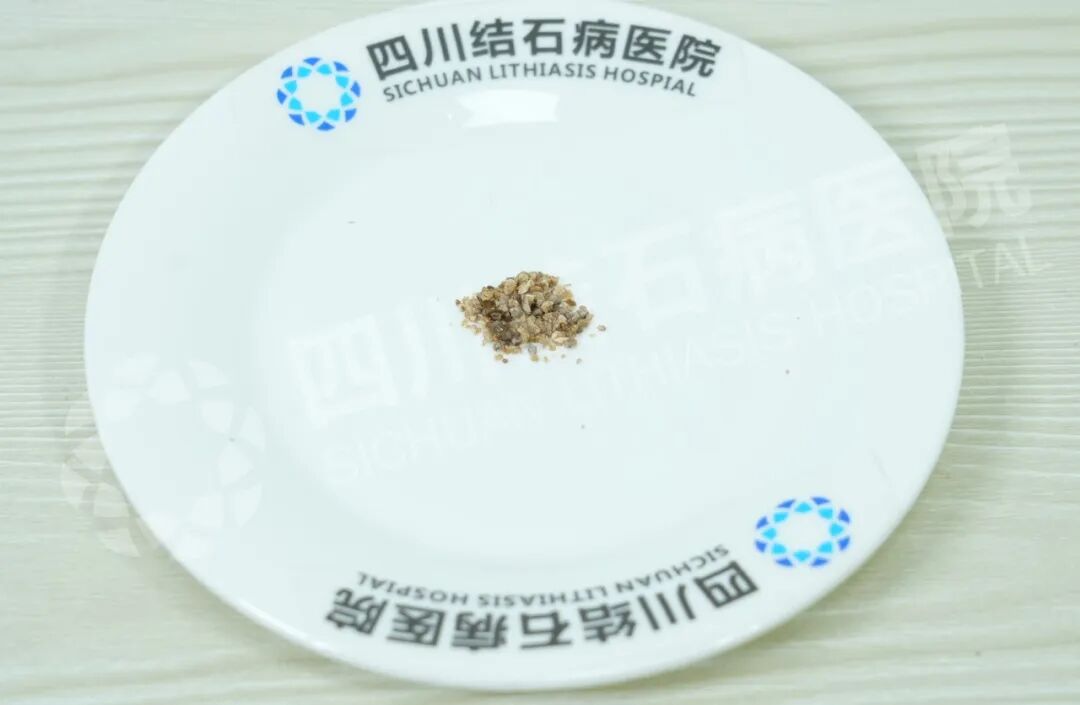 多家医院“考察”后,他为何还是回四川结石病医院治肾结石?(图1) 多家医院“考察”后,他为何还是回四川结石病医院治肾结石?(图1)