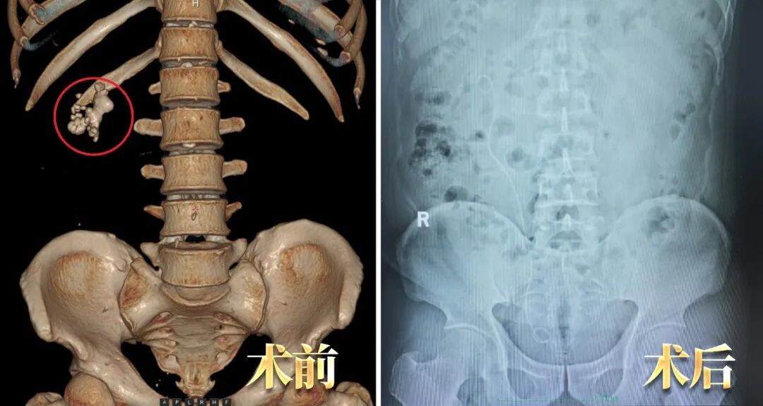 多家医院“考察”后,他为何还是回四川结石病医院治肾结石?(图2) 多家医院“考察”后,他为何还是回四川结石病医院治肾结石?(图2)