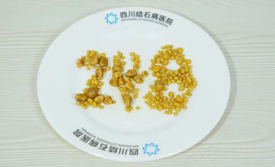 三餐靠外卖，偏爱冒菜炸鸡烧烤，26岁小伙胆囊内取出248颗结石(图1)