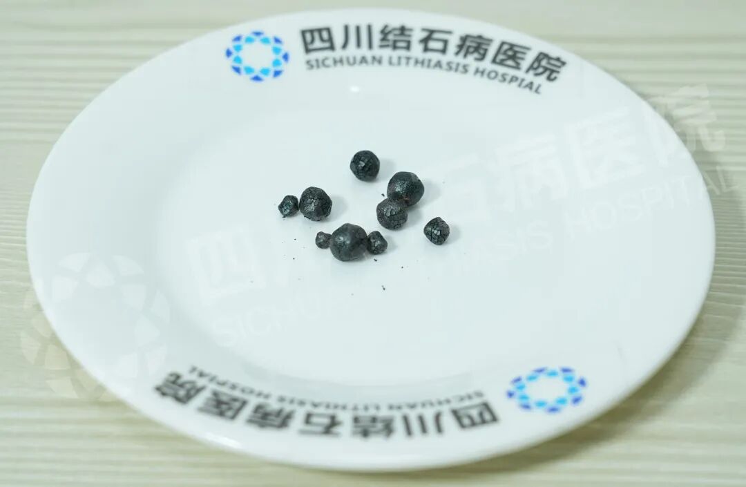 青海藏族大哥千里赴蓉  只为找陈红春主任保胆取石(图2)