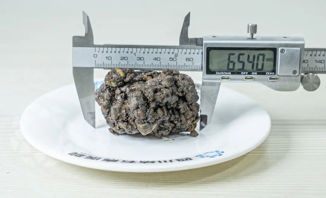 胆囊长“癞疙宝”结石？只因走错了这一步【四川结石病医院案例】(图1)