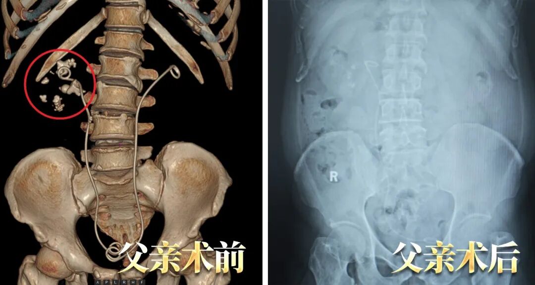 父子俩因泌尿结石同时入院！这个家庭习惯别忽视【四川肾结石医院】(图2)