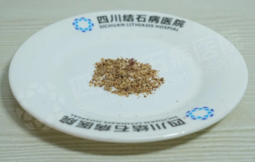 父子俩因泌尿结石同时入院！这个家庭习惯别忽视【四川肾结石医院】(图3)