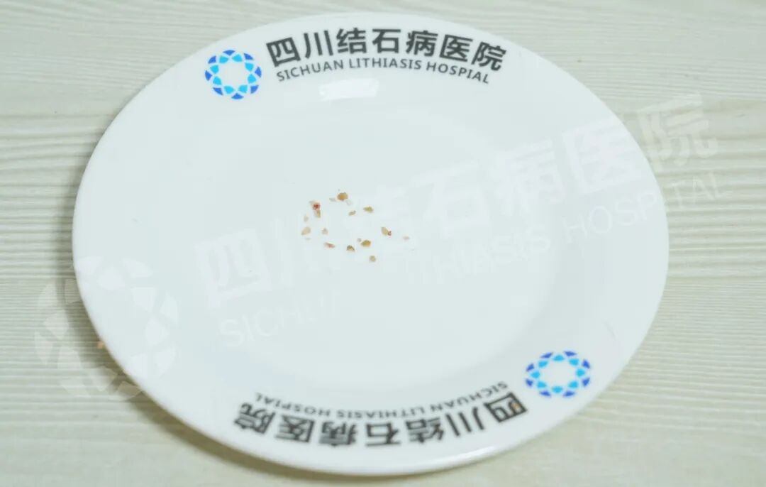 父子俩因泌尿结石同时入院！这个家庭习惯别忽视【四川肾结石医院】(图4)
