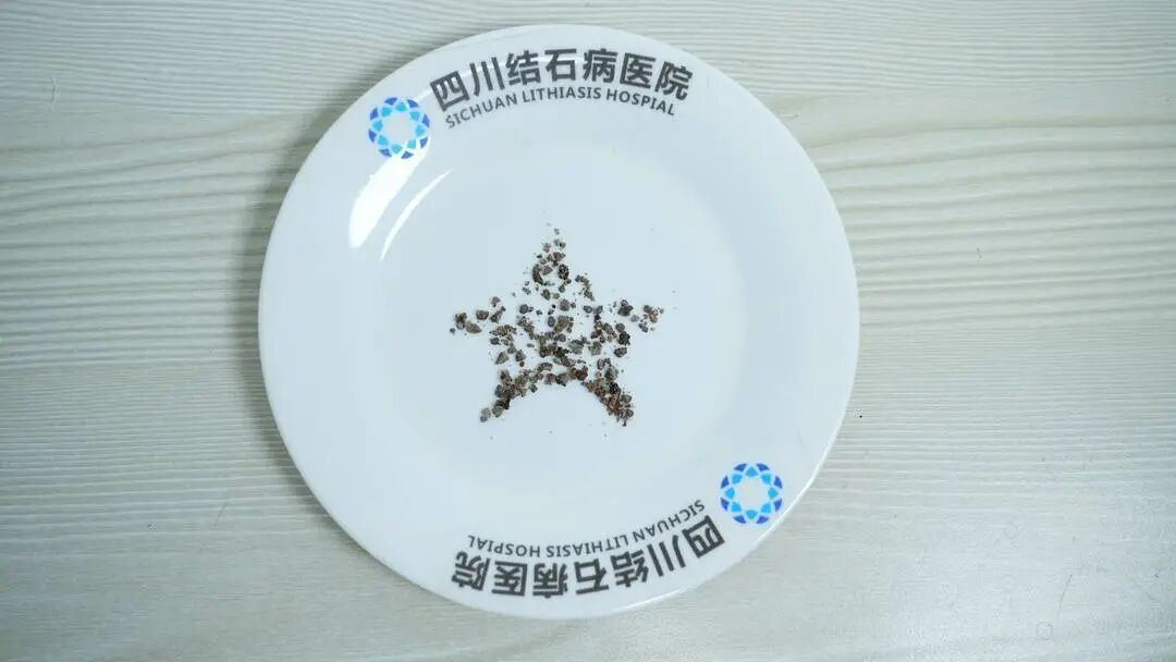 男子酷爱喝浓茶，茶叶能占半个杯子，双肾结石反复“疯长”10余年，最大的直径超过两厘米，医生提醒(图4)