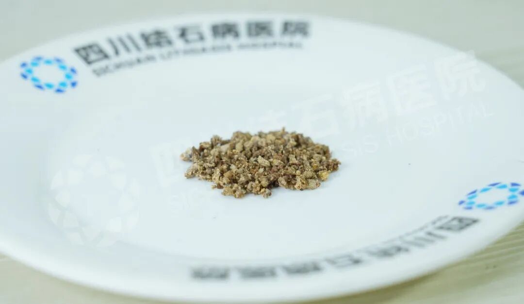 双肾大结石,外院说要腰部打孔,他却“无孔”取净?关键在这(图1) 双肾大结石,外院说要腰部打孔,他却“无孔”取净?关键在这(图1)