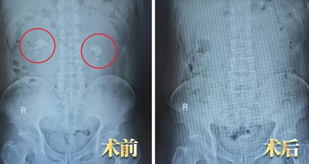 双肾大结石,外院说要腰部打孔,他却“无孔”取净?关键在这(图2) 双肾大结石,外院说要腰部打孔,他却“无孔”取净?关键在这(图2)
