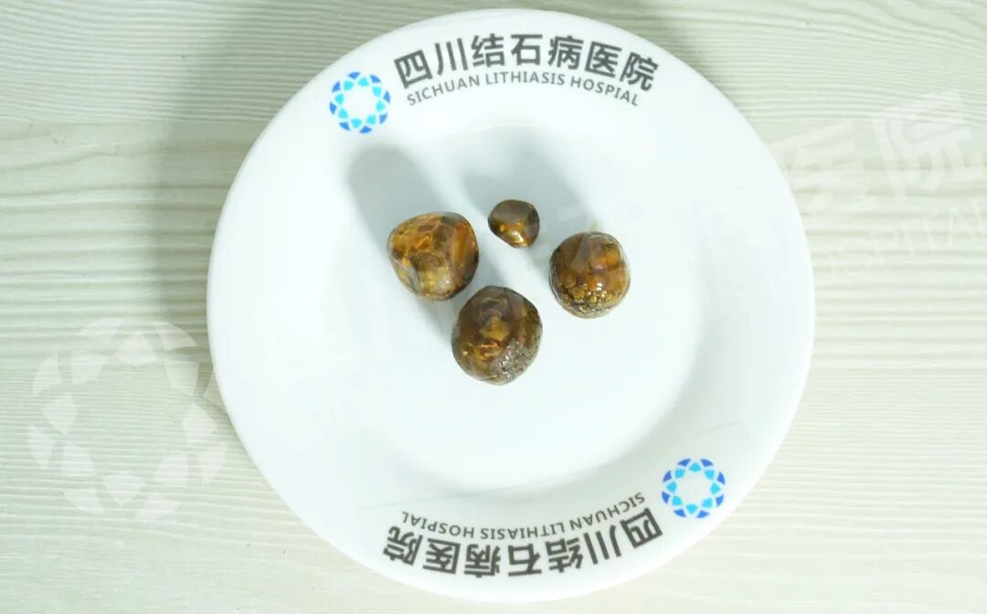 不疼的胆结石，为什么医生最怕你“再等等”【四川结石病医院 成都只有一家！】(图2)