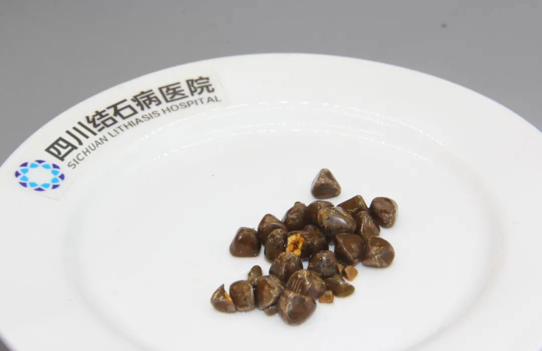 查出胆囊结石，想保胆又怕复发？先看这个指标【成都只有一家结石专科】(图5)