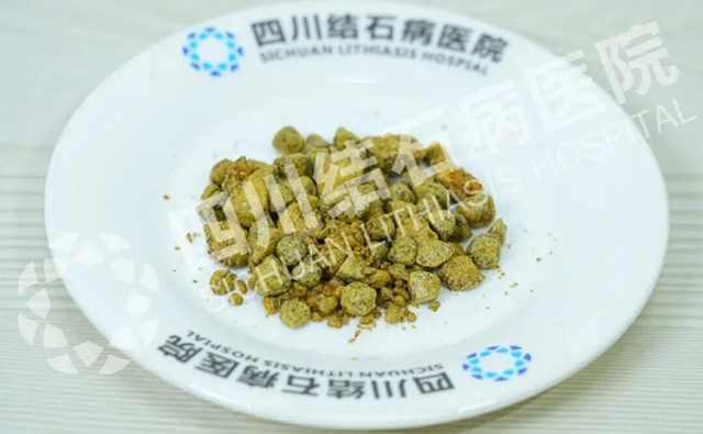半夜腰杆痛醒？输尿管结石在“搞事”，一定要认清它【成都仅一家结石专科】(图3)