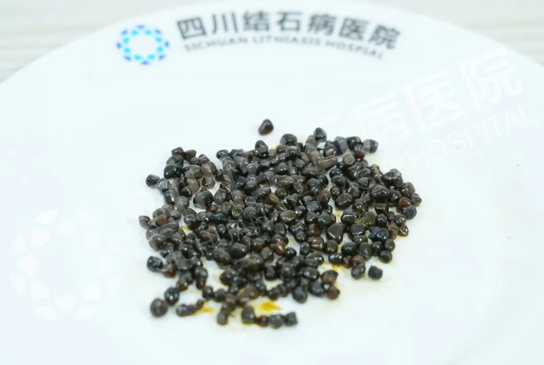 连夜抢救！医生痛心：查出这种病千万别拖【四川结石病医院，成都只有一家结石专科】(图1)