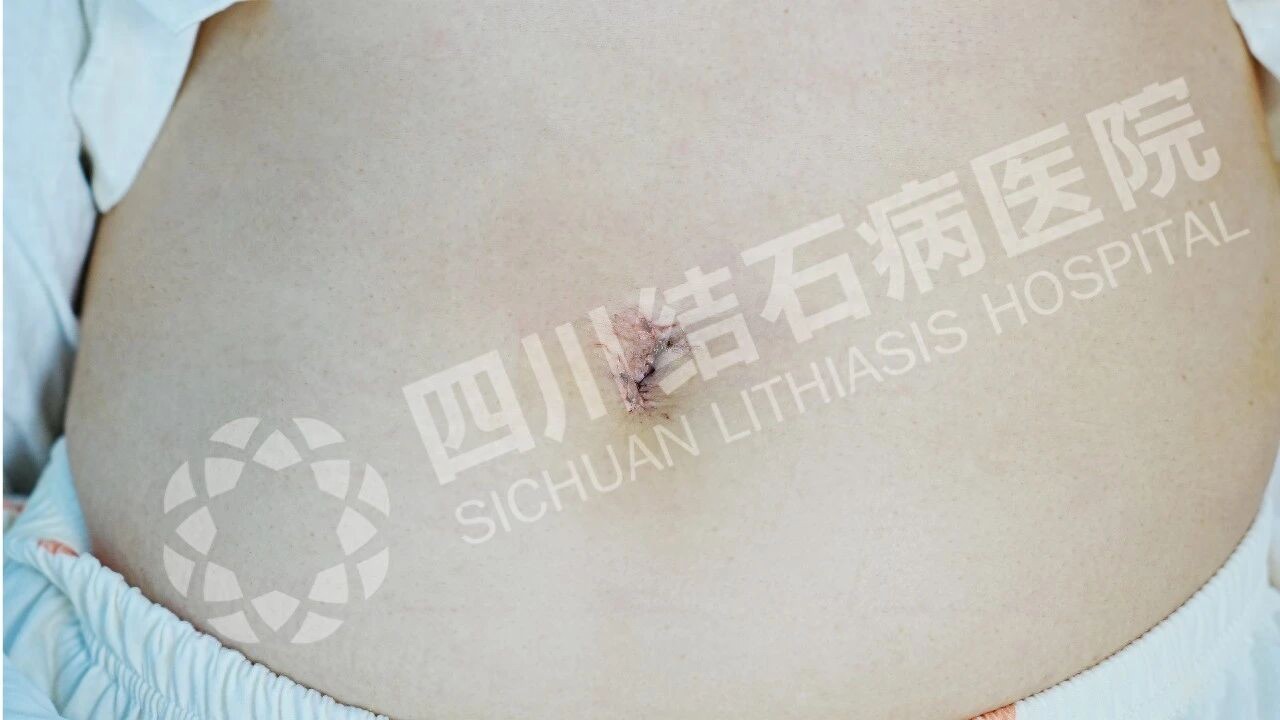 查出胆囊结石，想保胆又怕复发？先看这个指标【成都只有一家结石专科】(图3)