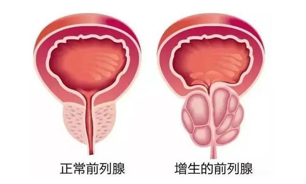 频繁起夜，谁能帮父亲跑完这场“马拉松”？ | 重阳献礼  “腺”在行动(图1)