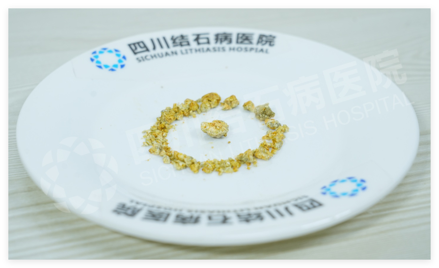 警惕胆结石低龄化，12岁女孩胆囊取出一盘结石！四川结石病医院专家：高脂饮食+三餐不规律是元凶！(图3)