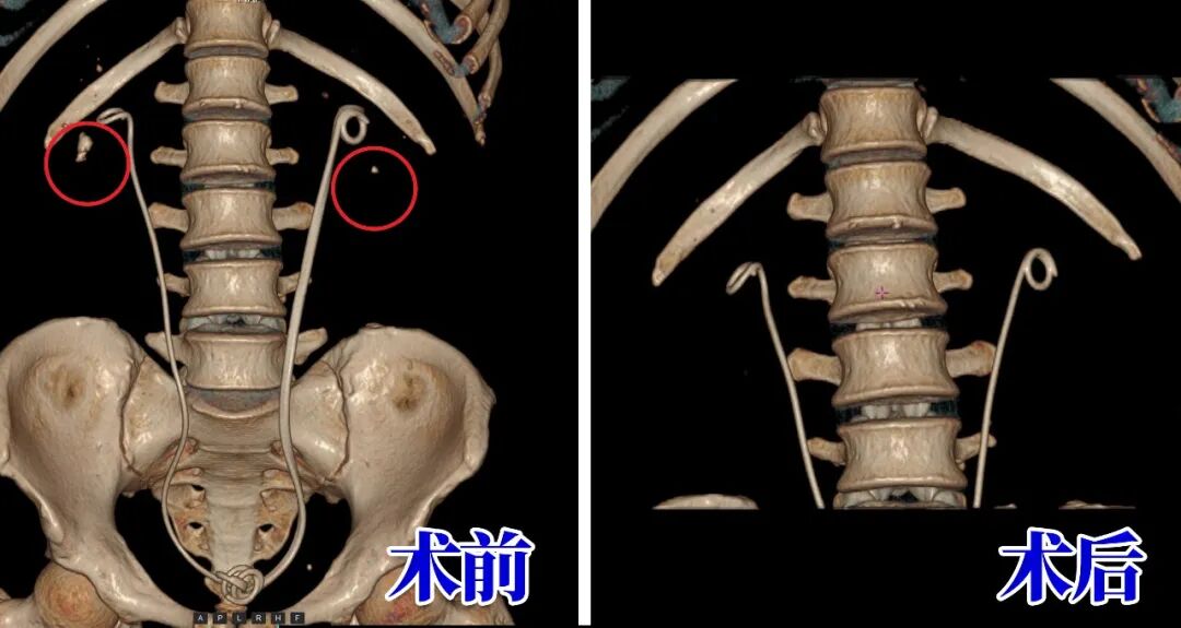 别被无症状结石骗了！姜先生亲身经历：小石头拖出大麻烦【四川肾结石医院】(图1)