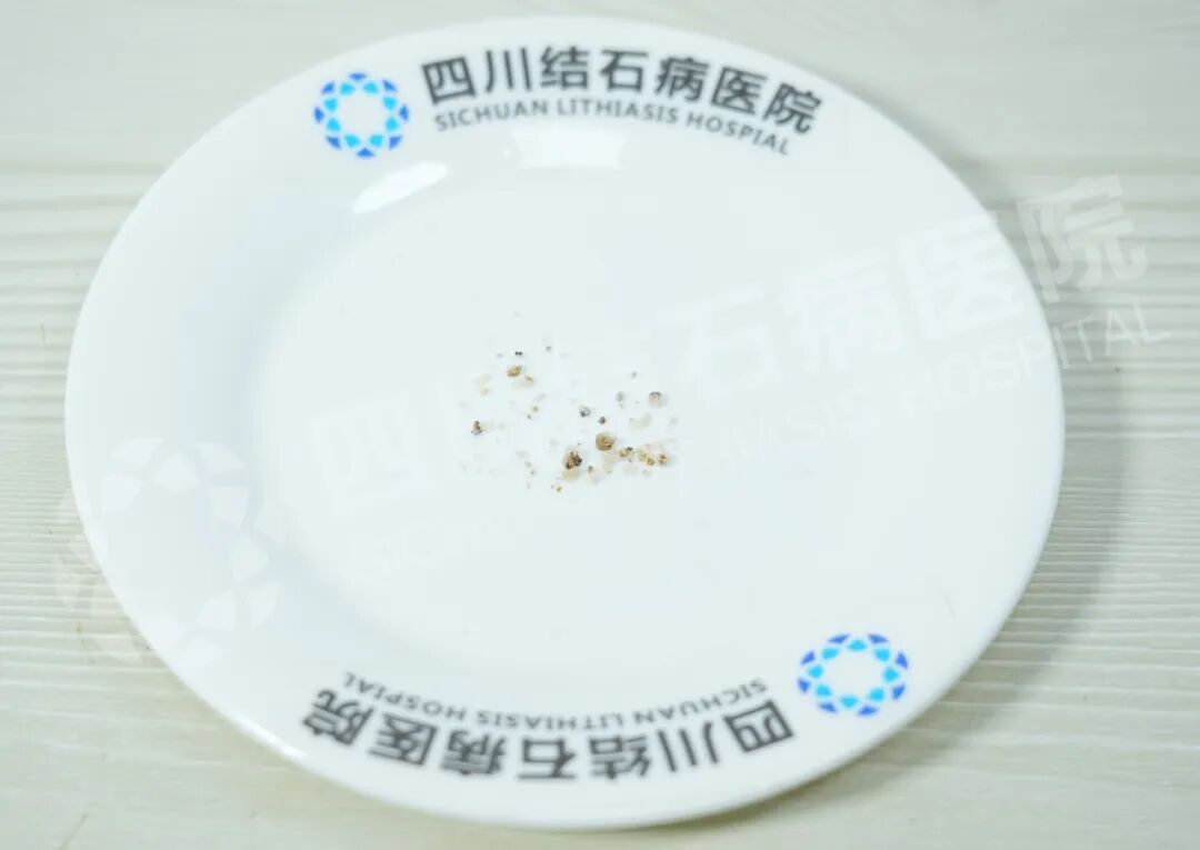 别被无症状结石骗了！姜先生亲身经历：小石头拖出大麻烦【四川肾结石医院】(图3)
