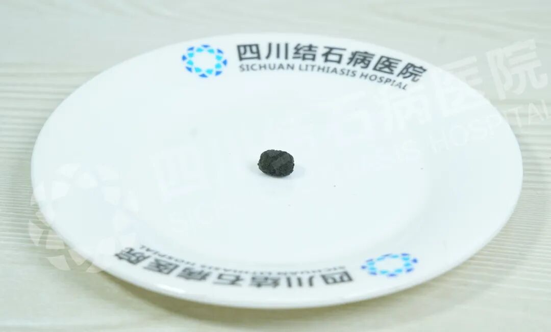 保胆取石选哪里？他们用“推荐亲友”投了票【四川结石病医院】(图4)